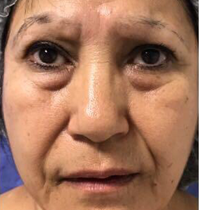 Blefaroplastia antes 2