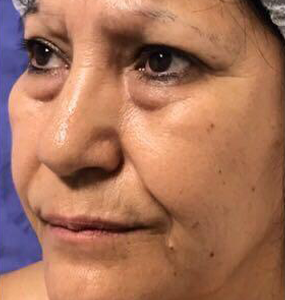 Blefaroplastia antes 3