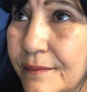 Blefaroplastia despues 3